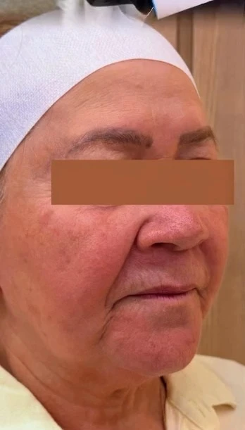 Antes: Linhas de marionete e perda de sustentação