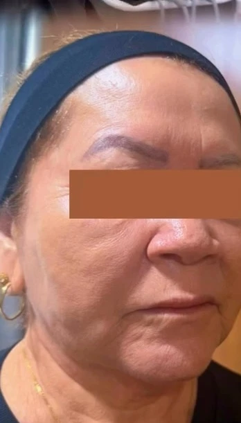 Depois: Linhas de marionete e perda de sustentação