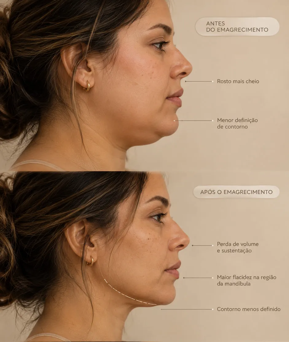 Comparativo em perfil: o rosto antes e depois do emagrecimento, com perda de sustentação na mandíbula